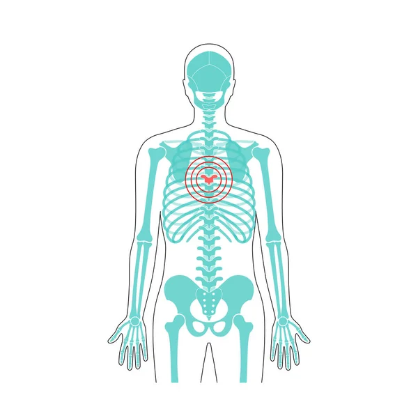 Ilustración del vector de dolor espinal humano — Archivo Imágenes Vectoriales