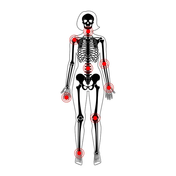 Dolor articular en el esqueleto del cuerpo humano — Vector de stock