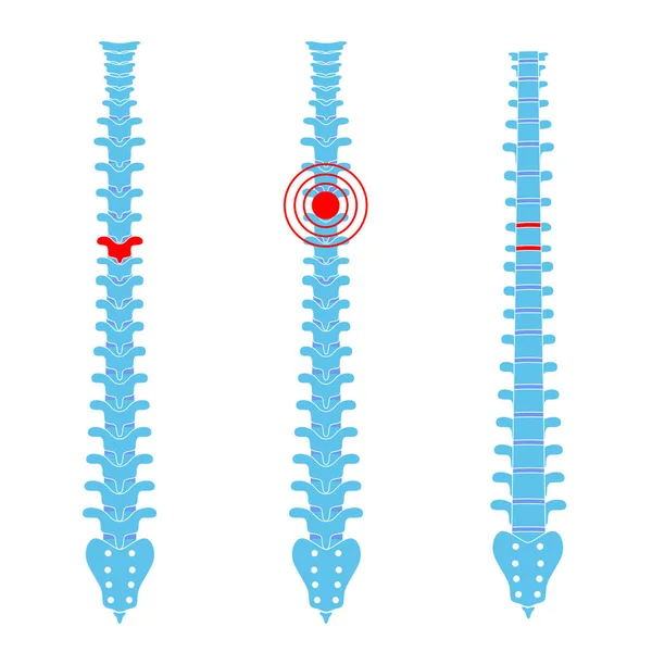 Ilustración del vector de dolor espinal humano — Archivo Imágenes Vectoriales