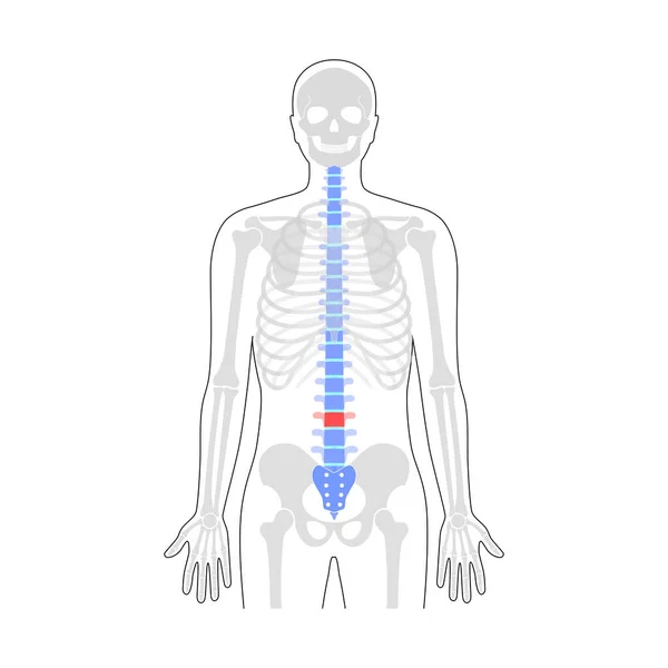 Illustrazione del vettore del dolore spinale umano — Vettoriale Stock
