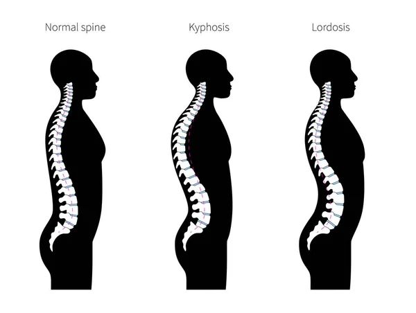 Cifosis, lordosis ilustración vectorial plana . — Vector de stock