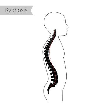 Kyphosis düz vektör çizimi.