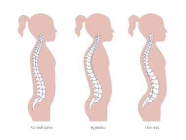 Kyphosis, lordosis düz vektör çizimi.