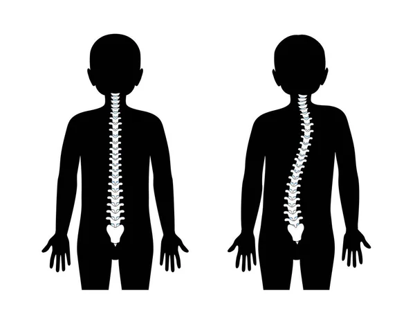 Scoliosis flat vector illustration — Stock Vector