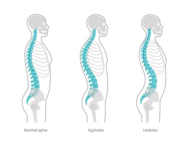 Kyphosis, lordosis düz vektör çizimi.