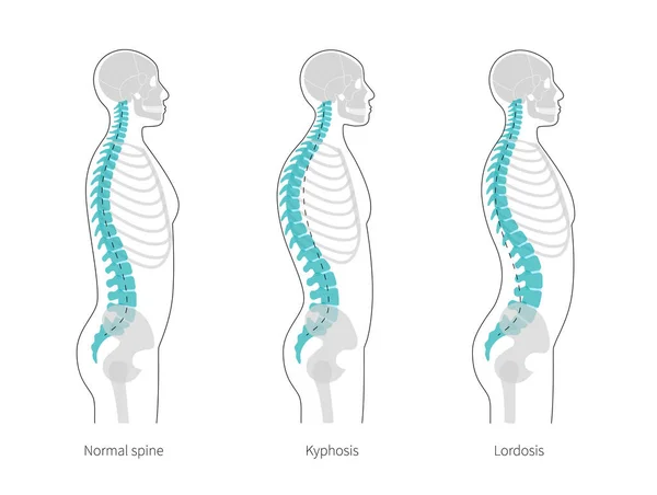 Kyphosis, lordosis flat vector illustration. — 图库矢量图片