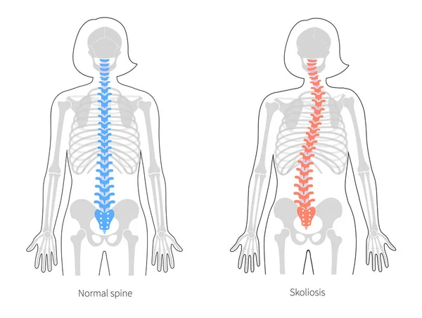 Scoliosis lapos vektor illusztráció — Stock Vector