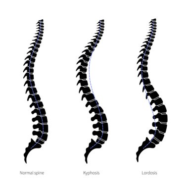 Kyphosis, lordosis düz vektör çizimi.