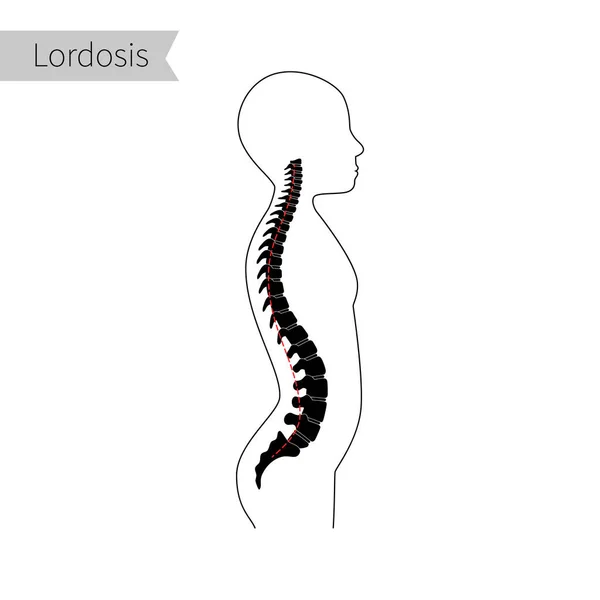 Lordosis platte vector illustratie. — Stockvector