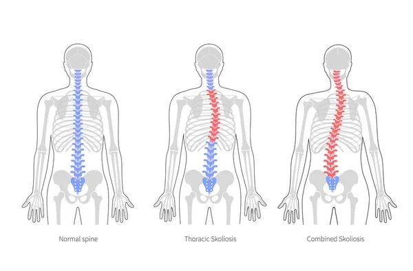 Escoliosis ilustración vectorial plana — Vector de stock