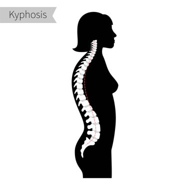 Kyphosis düz vektör çizimi.