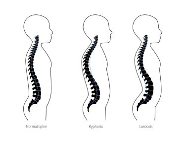 Kyphosis, lordosis düz vektör çizimi.