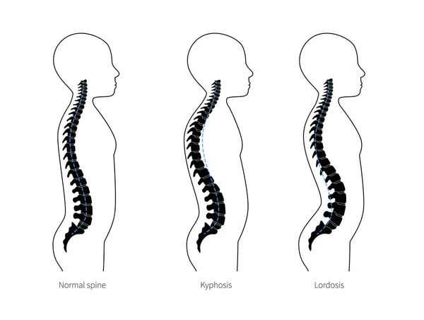 Kyphosis, lordosis flat vector illustration. — Stockový vektor