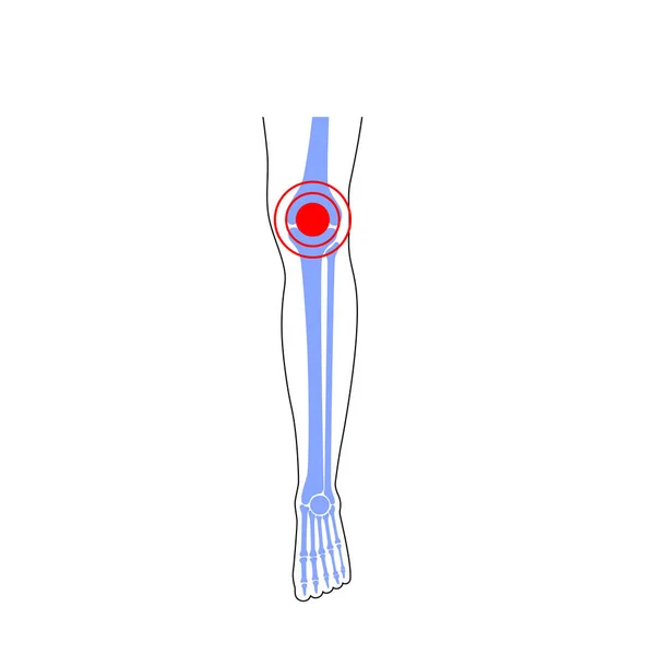 Dolor en la articulación de rodilla — Archivo Imágenes Vectoriales