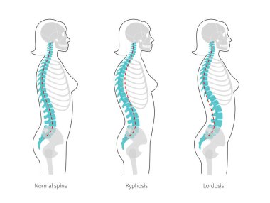 Kyphosis, lordosis düz vektör çizimi.