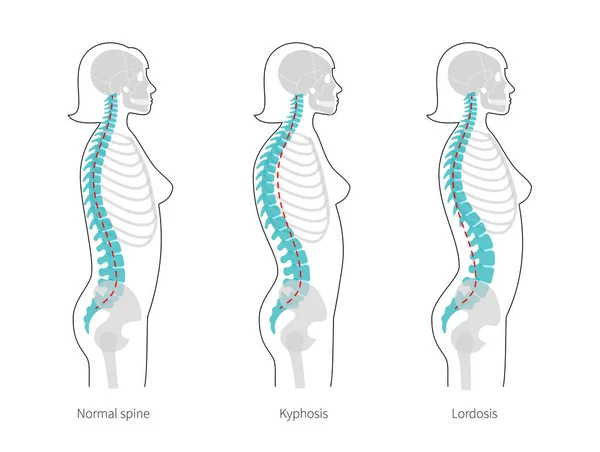 Kyphosis, lordose ilustração vetorial plana . —  Vetores de Stock