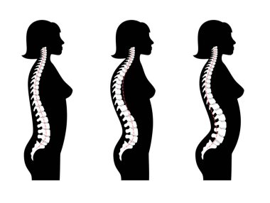 Kyphosis, lordosis düz vektör çizimi.
