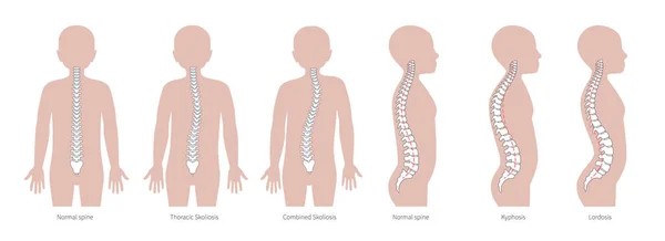 Boy spinal deformity flat vector illustration — Stock Vector