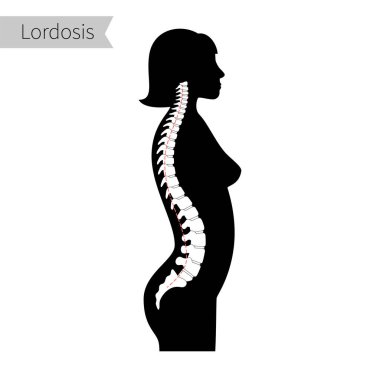 lordosis düz vektör çizimi.