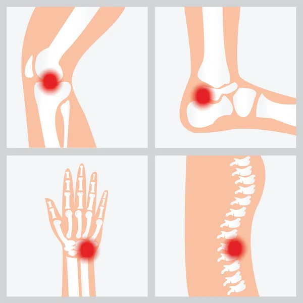 Disease of the joints and bones. — Stock Illustration Disease of the joints and bones. Stock Illustration