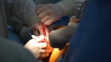 Ortopedik Cerrahlar coxal ortak bir odada bahtsız bir hastanın coxal esrar ateşlenmesine Ortopedik Cerrahlar elektrikli aletleri kırmızı bir delik ekleme bir kırmızı delik A çarpıcı closeup elektrik aletleri kullanarak bir yanık