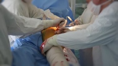 Ortopedik Cerrahlar Ortopedik Cerrahlar hastanın kalça coxal ortak bir değiştirme sırasında bir insan bacak kırmızı bazı dokudan çekerek bir odası A çarpıcı closeup ortak coxal bir insan büyük bir metal çubuk takılı