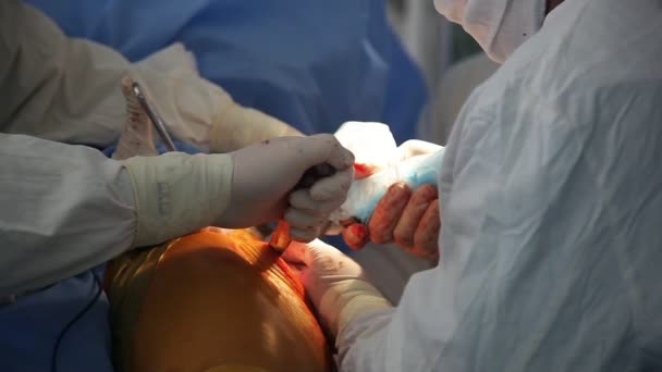 Chirurghi Ortopedici Riparano Articolazione Coxale Umana Attraverso Grande Buco Rosso — Video Stock