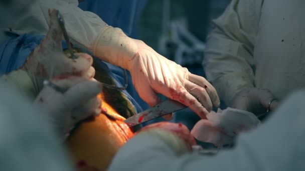Ortopéd Sebész Beszúrt Nagy Csavarhúzó Fém Stick Egy Emberi Test — Stock videók