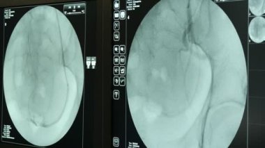 Modern Xray cihazı kardiyovasküler sistem bir hastanın bir state-of-art X-ray kardiyovasküler sistemden atar ve toplar damarlardaki inceleyerek siyah zemin iki ekranları ile özgün bir görünümünü denetler.