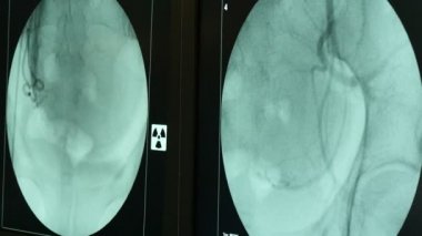 Yenilikçi Xray cihazı kardiyovasküler sistem hasta A çarpıcı görünümünün nasıl yönlendirdiğini x-Ray ile kardiyovasküler sistemden atar ve toplar damarlardaki kontrol siyah zemin içinde iki perde inceliyor.