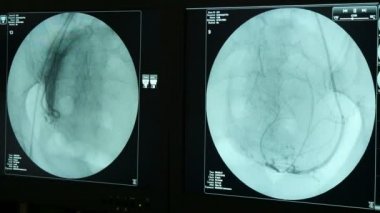 Modern bir röntgen cihazın bir kadının meme karanlık atar ve toplar damarlardaki bir X-ray cihazı dairesel bir monitörde titreşen ile özgün bir görünüm dairesel bir mavi ekranda canlı kadın göğüs.