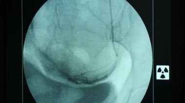 Bir modern X-ray cihazı A çarpıcı görüş siyah atar ve toplar damarlardaki ile hareketli bir kadın meme yenilikçi bir röntgen cihazın dairesel bir monitörde büyük bir mavi ekranda bir nefes kadın meme.