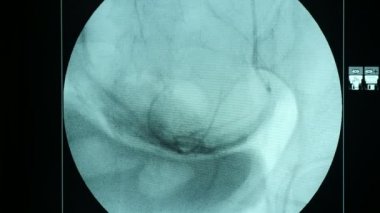 Siyah zemin bir cerrahi işlemleri için yardımcı bir büyük yuvarlak ekran ile siyah arka plan çağdaş bir X-ray cihazı Closeup büyük bir mavi ekran ile neoteric Xray inceden inceye gözden geçirmek