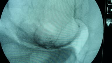 Mavi perde-in bir Xray cihazı arterler makro bir yenilikçi Xray inceden inceye gözden geçirmek ile kadın göğüsleri büyük bir dairesel mavi monitör kadınların mamografi inceleyerek incelenmesi. Siyah kan damarları üzerinde bazen görünür