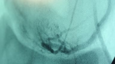 Mavi ekran siyah kan damarları Closeup bir yenilikçi Xray inceden inceye gözden geçirmek ile meme hastaların sağlığını denetleme mavi bir ekranla inceleyerek bir modern Xray inceden inceye gözden geçirmek. Kan damarları twinkle, görünür ve dissapear.