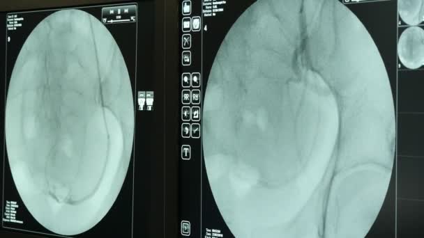 Σύγχρονη Συσκευή Xray Ελέγχει Ένα Καρδιαγγειακό Σύστημα Του Ασθενούς Μια — Αρχείο Βίντεο