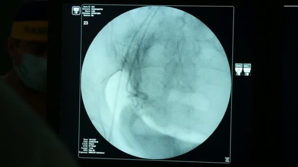 State Art Xray Monitör Siyah Zemin Bir Cerrahi Müdahale Yapmak — Stok video