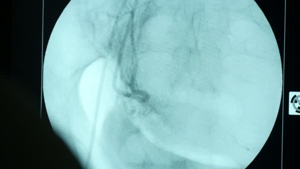 Kesme Kenarı Xray Tarayıcı Büyük Bir Dairesel Ekrana Bir Cerrahi — Stok video