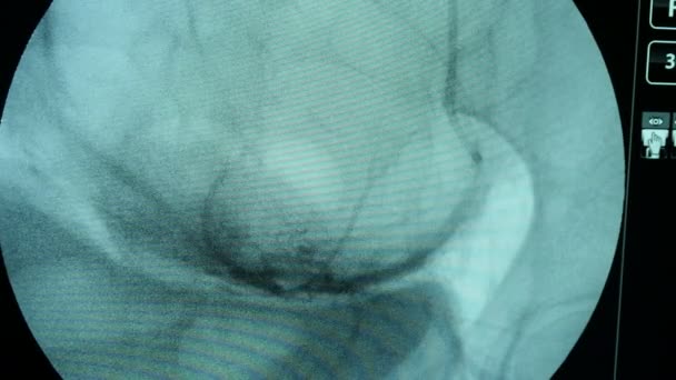 Круглый Синий Экран Рентгеновского Прибора Осматривающего Женскую Грудь Артериями Макро — стоковое видео