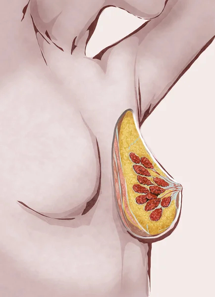 Illustrazione di donna con cancro al seno — Foto Stock