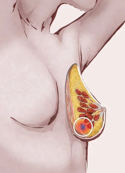 Illustrazione di donna con cancro al seno — Foto Stock