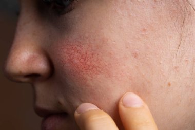 Genç bir kadının yanak derisindeki Rosacea kırmızısı yakın çekim.
