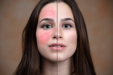 Genç beyaz bir kadın, Rosacea 'nın belirtilerini ortadan kaldırmak için yoğun lazer tedavisinin sonuçlarını gösteriyor. Yanak kızarıklığında gözle görülür bir azalma