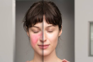 rosacea, before and after the cosmetic treatment of skin disorders clipart