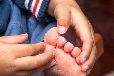 Juvenile plantar dermatosis is a common and chronic dry skin condition of the feet that affects children clipart