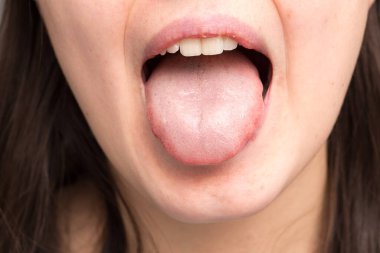 Candisiasis in tongue of girl clipart