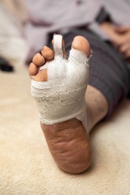 Hallux valgus ameliyat edildi. Ayak tabanı bantlanmış, şiş ameliyatı sonrası.