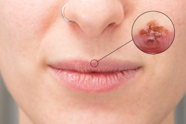 Herpes simpleks enfeksiyonu, viral bulaşma konseptini tedavi et ve önle
