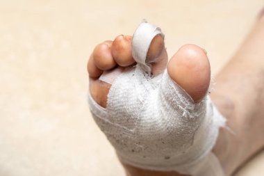 Hallux valgus 'un ortopedik düzeltilmesi ve ikinci ayak parmağının düzeltilmesi. Eklem iyileşmesini hızlandırmak için işlevsel bandajlar