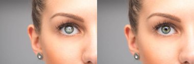 Female eye before and after cataract removal clipart